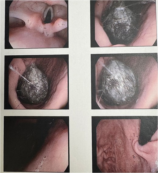 Upper endoscopic view showing a large gastric trichobezoar occupying approximately 90% of the gastric lumen and causing near-complete luminal obstruction.
