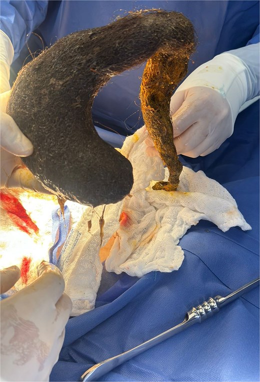 Surgical specimen showing a giant gastric trichobezoar with a long tail extending into the duodenum, consistent with Rapunzel syndrome.