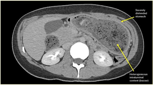 Axial contrast-enhanced CT image showing marked gastric distension with heterogeneous intraluminal content consistent with a large gastric trichobezoar causing gastric outlet obstruction.