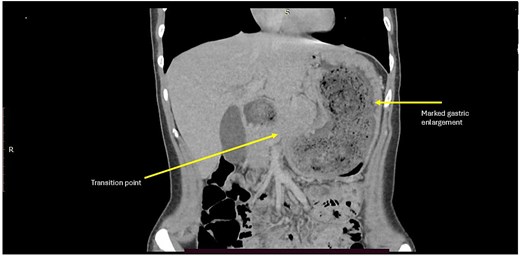 Coronal CT reconstruction showing marked gastric enlargement, proximal duodenal dilation, and a transition point consistent with gastric outlet obstruction.