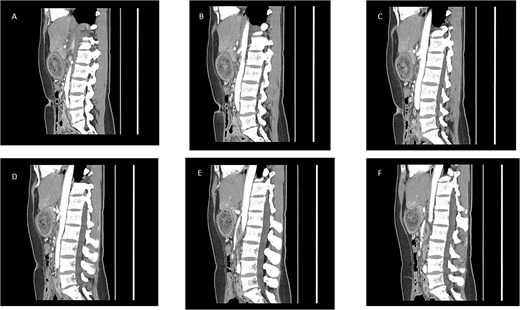 Sequential sagittal contrast-enhanced CT reconstructions showing marked gastric distension, proximal duodenal narrowing, and reduced aortomesenteric angle, findings suggestive of superior mesenteric artery syndrome associated with a giant gastric trichobezoar.
