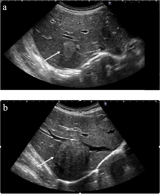 Two abdominal ultrasonography images show a hyperechoic mass in hepatic segment 7 indicated by arrows. The mass measured 23 mm at initial examination (a) and enlarged to 68 mm one year later (b).