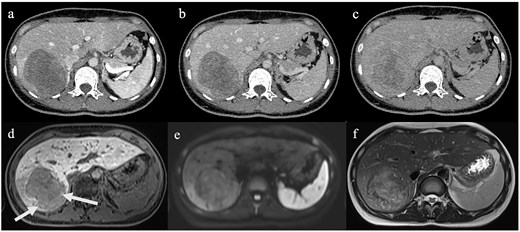 Six computed tomography and magnetic resonance imaging images show a 76-mm mass in hepatic segment 7. Contrast-enhanced computed tomography images show heterogeneous enhancement that gradually increases from the arterial phase to the delayed phase. Gadoxetic acid-enhanced magnetic resonance imaging shows predominantly reduced uptake in the hepatobiliary phase with focal hyperintense areas, no restricted diffusion on diffusion-weighted imaging, and heterogeneous hyperintensity on T2-weighted imaging.