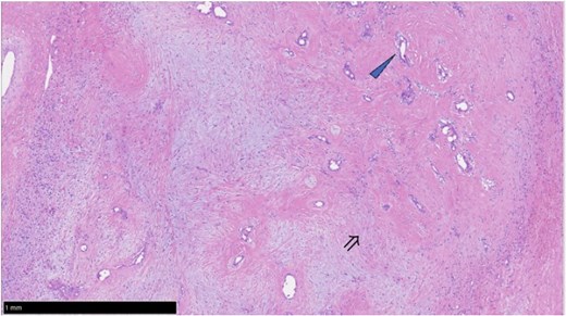 Hematoxylin and eosin-stained histopathological image shows abundant fibromyxoid to fibrous stroma with scattered irregular bile duct-like structures indicated by an arrowhead and spindle-shaped mesenchymal cells indicated by a double arrow. No significant cytologic atypia, necrosis, or increased mitotic activity is evident.