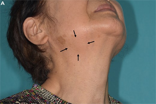 Clinical photograph showing a localized swelling in the right submandibular region of an 80-year-old woman, corresponding to a palpable 25-mm mass.