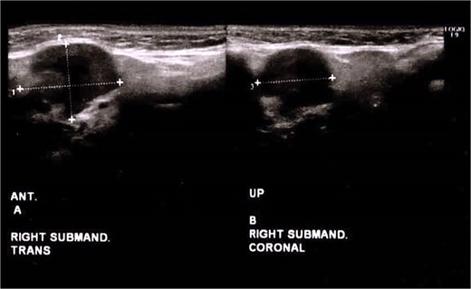 Ultrasonographic image showing a well-circumscribed solid mass adjacent to the right submandibular gland. No beak sign is present, suggesting a lack of continuity between the mass and the gland.