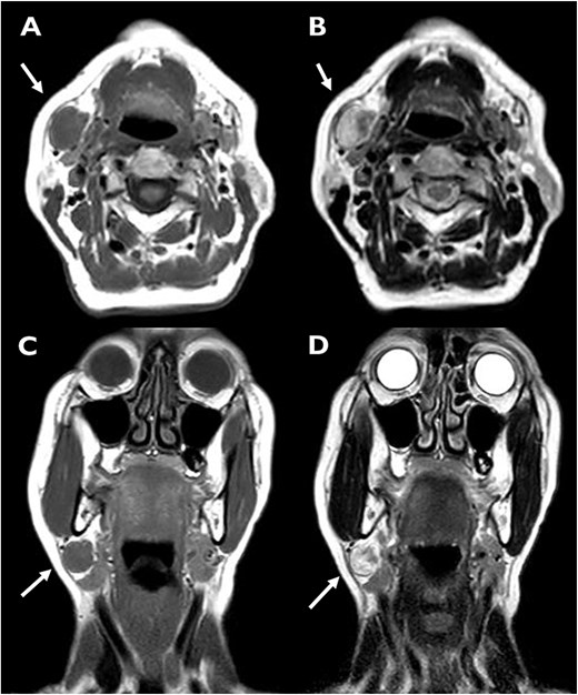 MRI demonstrating a well-circumscribed right submandibular mass with low T1 and heterogeneous high T2 signal intensity. A preserved fat plane is visible between the tumor and the submandibular gland.