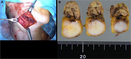 (A) Intraoperative view showing en bloc resection of the tumor with the submandibular gland and surrounding tissue. (B) Gross specimen showing a well-circumscribed encapsulated tumor located separately from the submandibular gland.