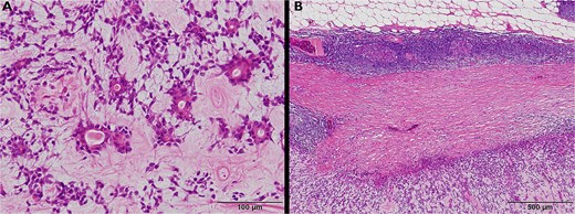 (A) Microscopic image showing ductal and spindle-shaped tumor cells embedded in myxoid and fibrous stroma, consistent with pleomorphic adenoma. (B) The tumor capsule is composed of fibrous and lymphoid tissue, supporting an origin from ectopic salivary gland tissue within a lymph node.