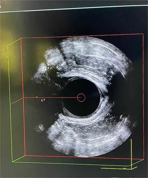EAU with two extensions of the complex perianal fistula.