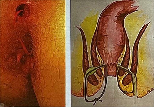 Loose seton as preparation for definitive treatment (left)—own case; (right)—schematic representation.