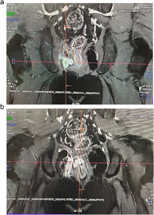 (a, b) MRI with contrast—H2O2–3% with visualization of the complex fistula with secondary extension.