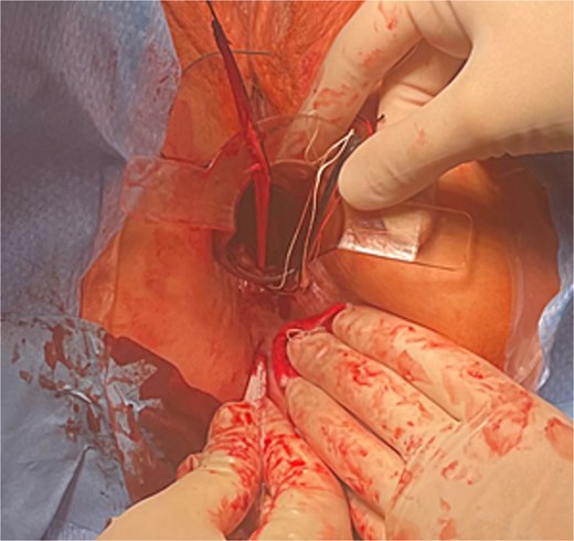 Debridement of a fistula tract with gauze tape.