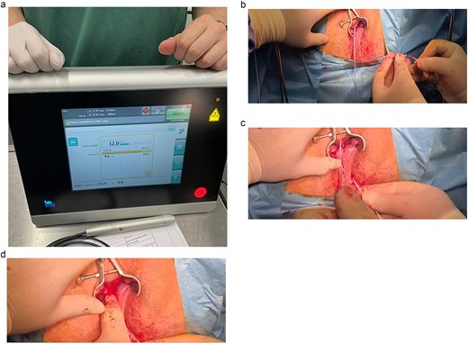 (a–d) Equipment used and sequential stages of performing the FiLAC procedure for dorsal fistula extension.