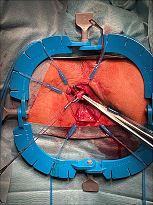 Dissected intersphincter segment of the main fistula tract and first suture ligature placed.
