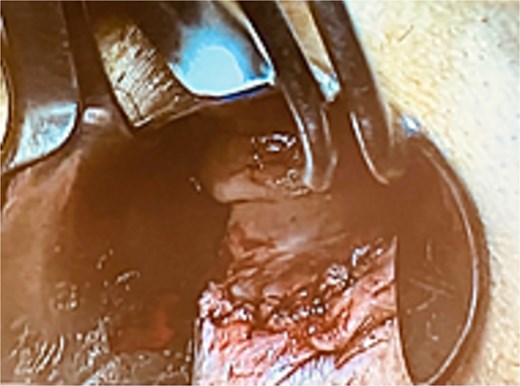 Formed mucosal flap covering the internal opening of the fistula.