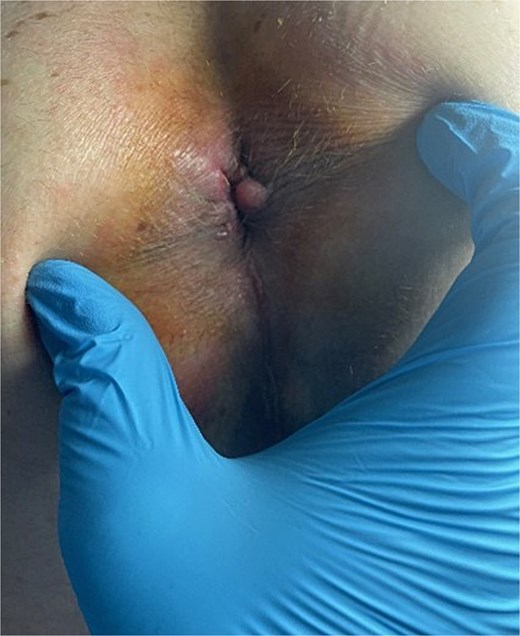 View of the operative field at the 11th postoperative month.