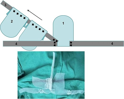 Artificial mesh pattern diagram and actual diagram
