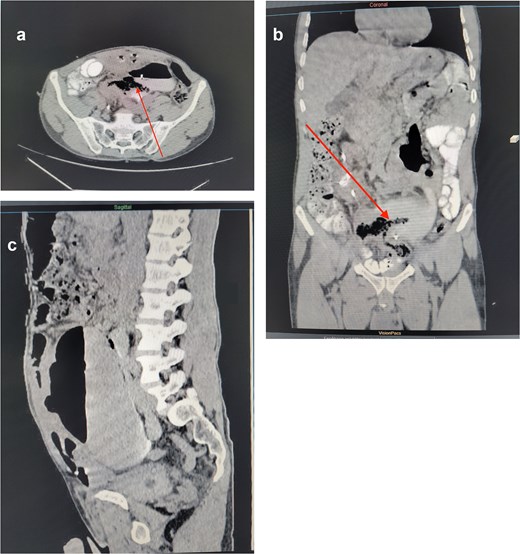 Preoperative imaging: Contrast-enhanced abdominal and pelvic CT scan (axial (A), coronal (B) and sagittal (C) sections). The image shows an ectopic left renal pelvis with significant pyelocaliceal dilatation. There is air present in the renal cavities (pneumopyelia) and a direct fistulous tract (arrow) between the renal pelvis and the sigmoid colon.Alt text: Three-panel preoperative abdominal and pelvic CT scans in axial, coronal, and sagittal views. The images show an ectopic left kidney with severe dilation of the renal pelvis and calyces. Air is visible inside the renal cavities, and a distinct fistulous tract is seen directly connecting the dilated renal pelvis to the adjacent sigmoid colon.