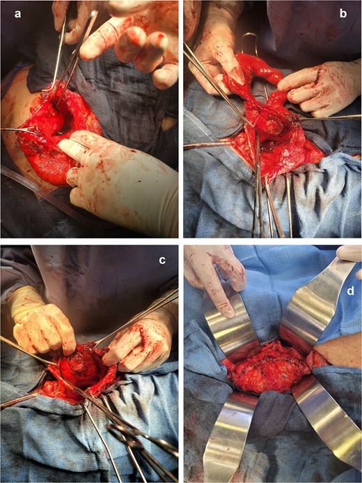 Four-panel intraoperative photographs during a median laparotomy. The first three panels show the open left renal pelvis following a pyelotomy, exposing an internal ureteral catheter and a visible fistulous opening that connects the renal cavity to the sigmoid colon lumen. The final panel demonstrates the reconstruction phase after segmental sigmoid resection and reduction pyeloplasty, showing the restored upper urinary tract with a double-J stent in place.