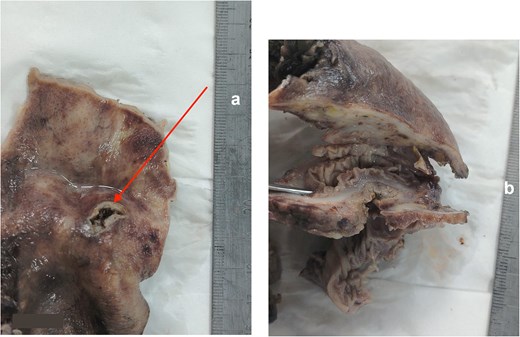 Two-panel macroscopical photograph of a single-piece surgical resection specimen fixed in formalin, containing a colonic segment and the pyelic wall. The first panel shows an internal view of the opened renal pelvis, displaying a fistulous orifice surrounded by heavily inflamed and remodeled mucosa. The second panel shows a cross-section of the divided fistulous tract, demonstrating the direct tissue communication and thick, dense inflammatory remodeling between the colonic and renal pelvis walls.