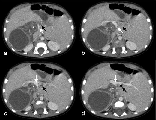 Four contrast-enhanced axial CT images showing a preduodenal portal vein coursing anterior to the pylorus and duodenum. The portal vein is marked by white arrows, the duodenum by black arrows, and the pylorus by asterisks.