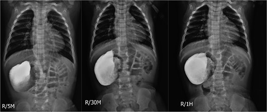 Three serial upper GI contrast study images at 5, 30, and 60 minutes showing progressive contrast retention in a right-sided stomach with superior pyloric displacement.