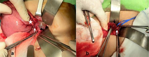 Two intraoperative photographs showing the preduodenal portal vein compressing the pylorus-duodenum junction and the mobilized pylorus-duodenum after transection.