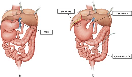 Two-panel schematic illustration showing the preoperative anatomy and postoperative reconstruction. Panel A shows a preduodenal portal vein crossing anterior to the pylorus-duodenum junction with mesentericoaxial gastric volvulus and intestinal malrotation. Panel B shows reconstruction after gastric derotation, ante-PDPV pyloroduodenostomy, anterior gastropexy, and jejunostomy tube placement.