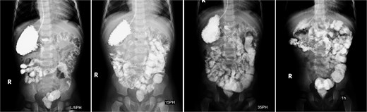 Four serial upper GI contrast study images at 6 weeks postoperatively demonstrating patent anastomosis with unobstructed contrast passage.