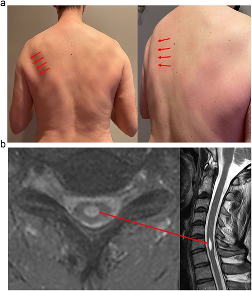 Figure 1 shows a clinical photograph and cervical spine MRI findings in Case 1. Panel a shows mild left scapular winging, with the affected scapular border indicated by red arrows. Panel b shows cervical syringomyelia at the C6 level, extending approximately 20 mm craniocaudally. The syrinx is visible as a hyperintense intramedullary lesion on axial mFFE and sagittal T2-weighted MRI images and is marked by a red arrow.