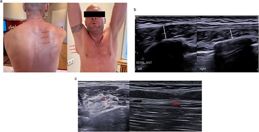 Figure 2 shows clinical and ultrasound findings in Case 2. Panel a shows right scapular winging with elevation of the medial scapular border, indicated by red arrows. Panel b shows sonographic evidence of slight atrophy of the right serratus anterior muscle. Panel c shows high-resolution ultrasound of the long thoracic nerve, demonstrating perifocal thickening in the axial view and an hourglass-shaped nerve constriction in the longitudinal view, both marked by red arrows.