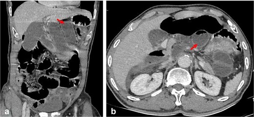 Coronal and axial CT images showing dilated bowel loops abnormally positioned behind the stomach within the lesser sac, indicated by arrows.