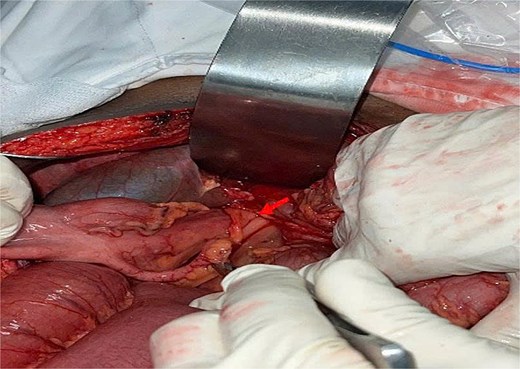 Surgical view showing bowel herniating through the foramen of Winslow, indicated by an arrow.