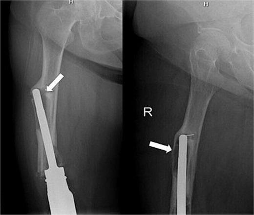 Anteroposterior and lateral radiographs of the femur showing loosening around the femoral stem of a knee arthrodesis construct.