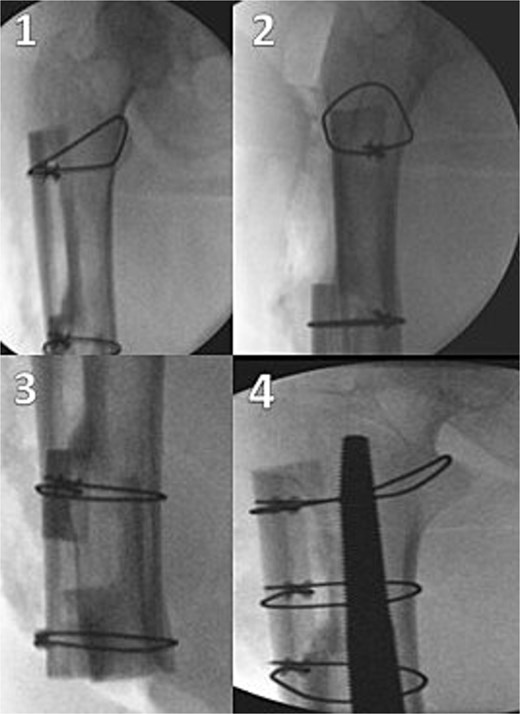 Intraoperative fluoroscopic images showing cortical strut allograft fixation with cerclage cables and implantation of the femoral revision component.
