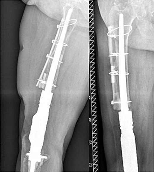 Postoperative anteroposterior and lateral radiographs showing the revised knee arthrodesis with cortical strut graft augmentation.
