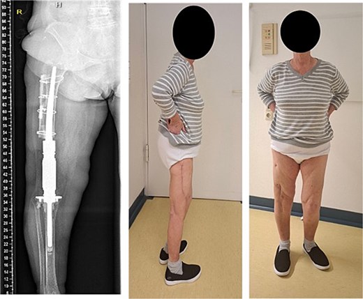 Follow-up radiograph and clinical photographs of the patient standing after revision knee arthrodesis, showing stable fixation, graft incorporation, and residual leg length discrepancy.