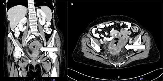Contrast-enhanced CT images of the abdomen and pelvis shown in coronal and axial views demonstrate a large distal sigmoid/rectal mass with central areas of necrosis.