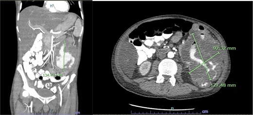 Contrast-enhanced CT images of the abdomen and pelvis shown in coronal (left) and axial (right) views showing a large heterogeneous soft-tissue mass at the splenic flexure measuring approximately 13 x 9 x 13 cm.