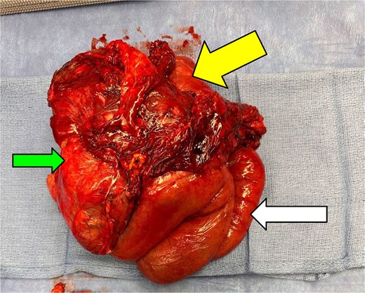 Gross photograph of the resected specimen. The green arrow indicates the colon, the yellow arrow indicates a necrotic perforated tumour mass, and the white arrow indicates the small bowel.