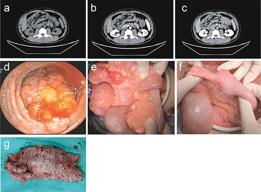 Preoperative, intraoperative, and postoperative macroscopic and imaging findings of the lesion,with subfigures labelled from a to g