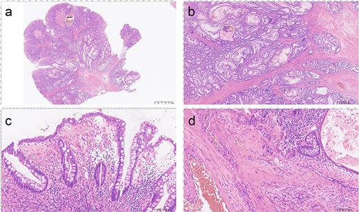 Histopathological features of the resected polyp via hematoxylin and eosin (H&E) staining with subfigures labelled from a to d.