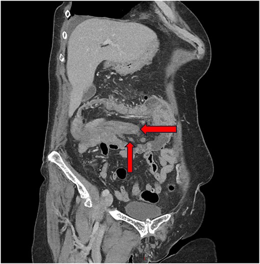 Coronal contrast-enhanced CT image demonstrating colonic intussusception with a characteristic bowel-within-bowel configuration, including invaginated mesenteric fat and vessels.