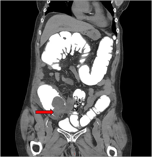 Coronal CT image following contrast enema demonstrating resolution of the intussusception and a caecal mass outlined by retrograde contrast.