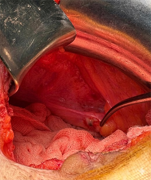 Per-operative view of the pelvis showing a pigmented peritoneal nodule.