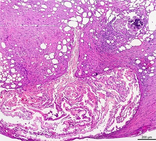 Microphotography of the peritoneal nodule at low magnification (×40) with standard hematoxylin and eosin staining showing deposits of pale, eosinophilic and light-yellowish material, organized in a festooned acellular pattern underneath the mesothelium, surrounded by inflammation and focal calcification.