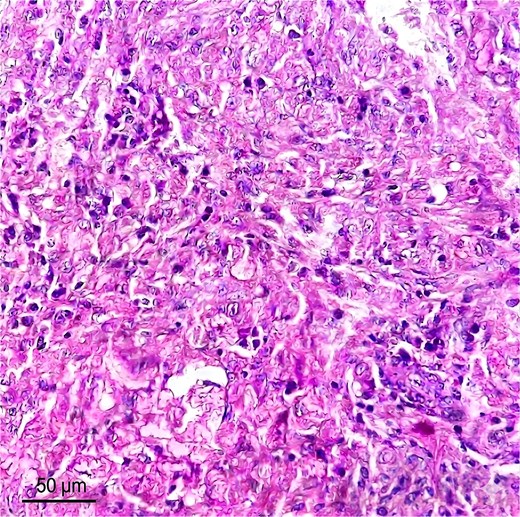 Microphotography of the peritoneal nodule at high magnification (×400) with standard hematoxylin and eosin staining showing a dense inflammatory infiltrate rich in macrophages, appearing either foamy or dotted with yellowish-brown pigments and surrounding the material deposits.
