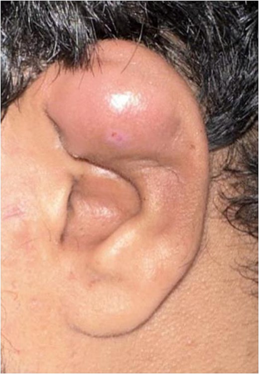 Clinical photograph of the external ear demonstrating a large smooth swelling involving the superior part of the auricle, causing distortion of the normal auricular contours with mild overlying erythema.