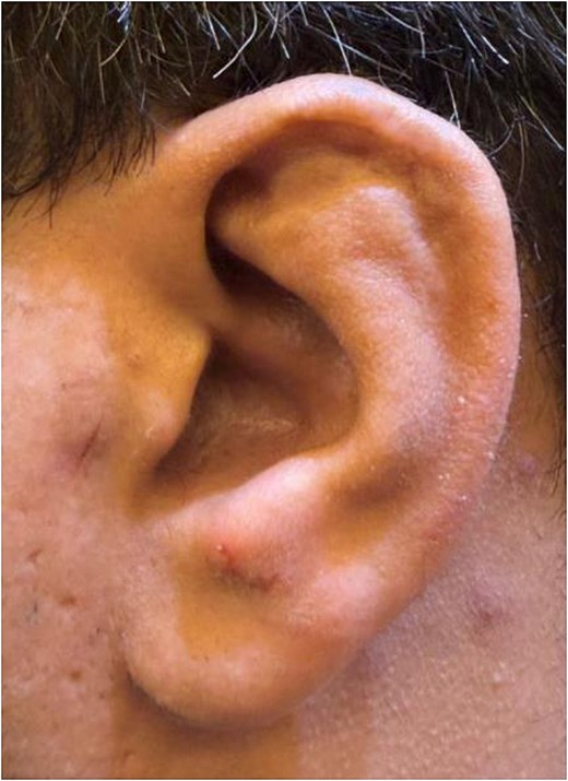 Clinical photograph of the ear on follow-up, showing marked reduction of the superior part of the auricular swelling with restoration of normal auricular contours and minimal residual deformity.